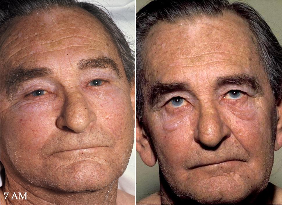 Man With Facial Plethora and Edema